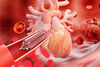 Stents in Herzkranzgefäßen: Akute Entzündung verdreifacht Risiko für Thrombosen