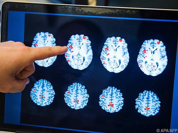 Kontrastmittel-Ablagerungen in MS-Gehirnen analysiert 