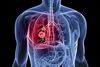 Screening zur Lungenkrebs-Früherkennung kann Sterblichkeit um 20 Prozent senken