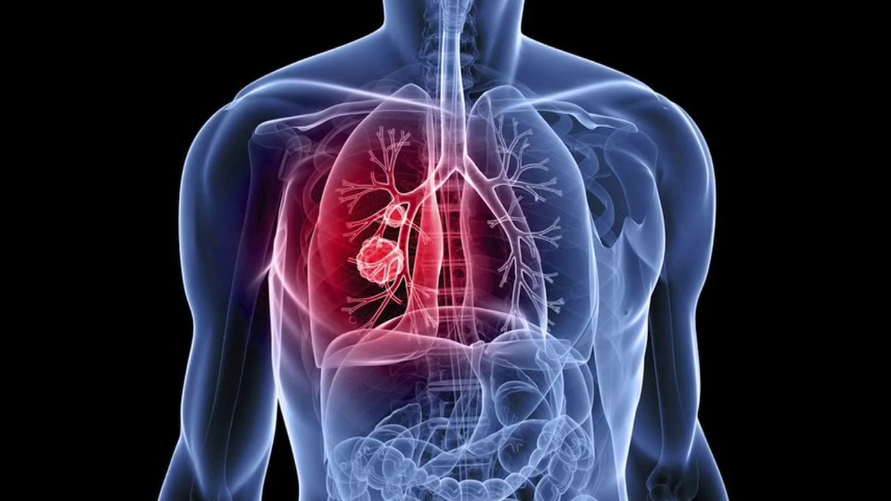 Screening zur Lungenkrebs-Früherkennung kann Sterblichkeit um 20 Prozent senken