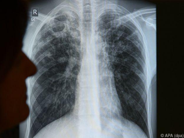 Tuberkulose