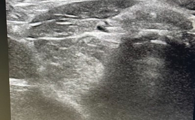 ЕНДОКРИНОЛОГИЯ: Хипотиреоидизъм при Тиреоидит на Хашимото thumb image