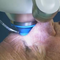 Отстраняване на катаракта с фемтосекунден лазер