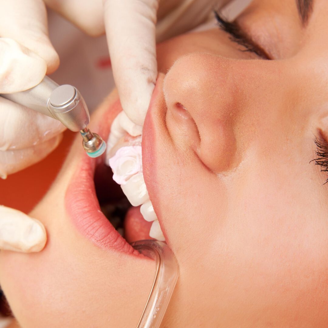 Чистка Зубов Цена