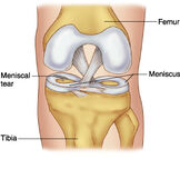 Контузия в коляното и увреда на менискуса