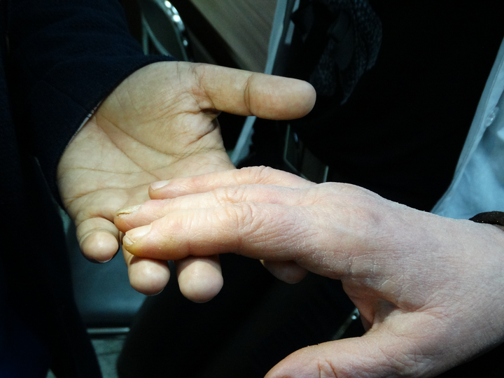 Над 30 пациенти преминаха през безплатните прегледи за гъбички по ноктите

