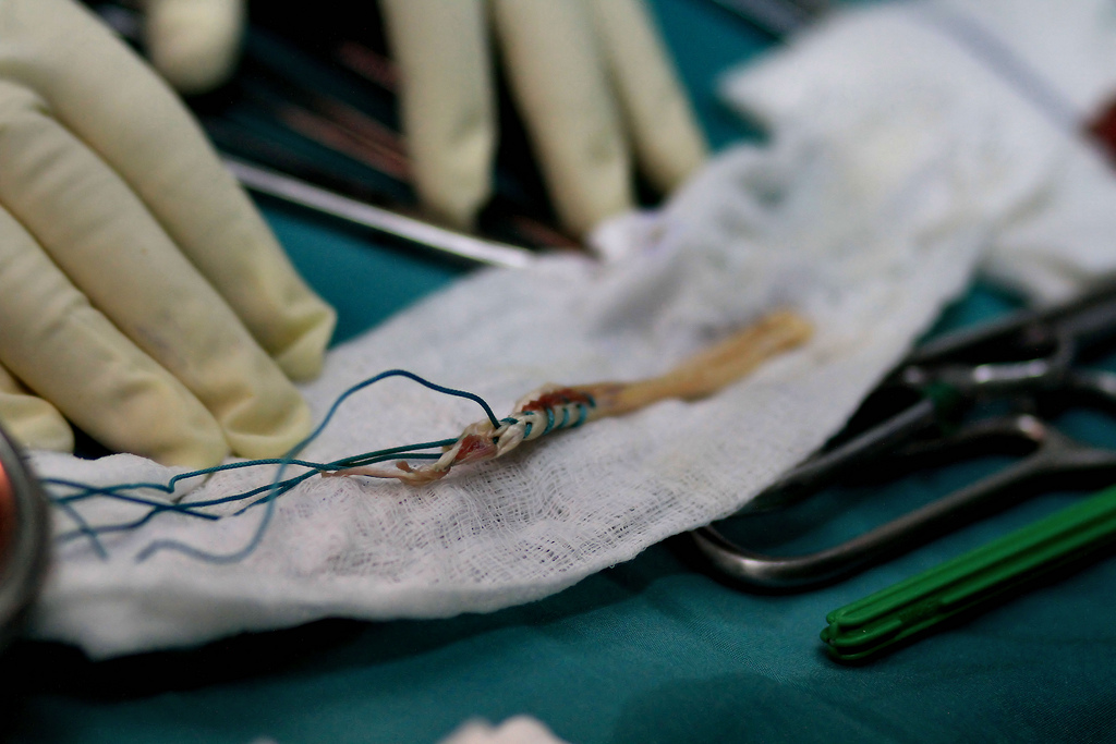 Ревизия на пластика на кръстна връзка: възстановяване на предната кръстна връзка чрез собствени сухожилия