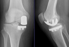 Ревизионно ендопротезиране: смяна на износена колянна става със съпътстващи  тежки костни дефекти и нестабилност 