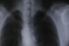 Безплатни прегледи за туберкулоза в Смолян