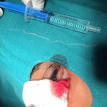 10 - сантиметров паразит извадиха от окото лекари от Очна клиника към УМБАЛ -  Плевен
