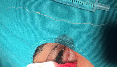 10 - сантиметров паразит извадиха от окото лекари от Очна клиника към УМБАЛ -  Плевен
