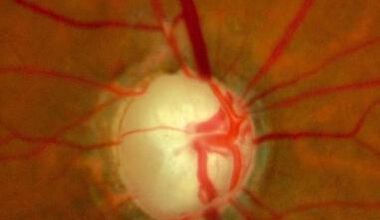 Посттравматична глаукома – видове и лечение