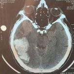 Неврохирурзи от УМБАЛ -Плевен спасиха живота на мъж изгубил съзнание докато шофира
