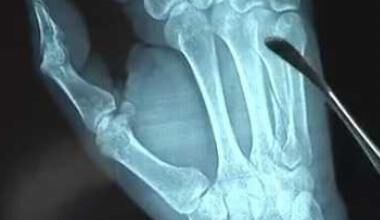 Хирургия на ръката (ВИДЕО)
