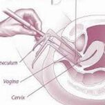 Премахване на болен участък от шийката на матката чрез LLETZ процедура