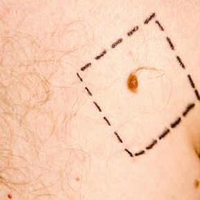 Онкодерматолозите съветват: Използвайте минимум 30 фактор на слънцезащита