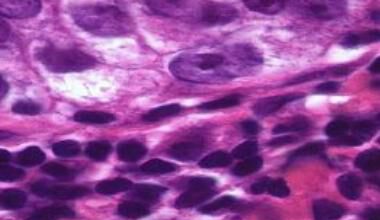 Лимфоцитната туморна инфилтрация като прогностичен и
предиктивен фактор при РМЖ