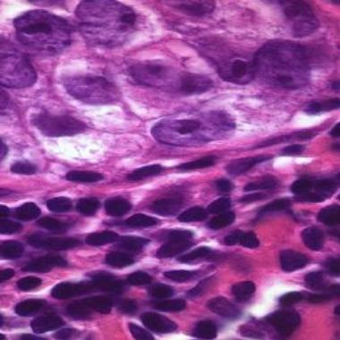 Лимфоцитната туморна инфилтрация като прогностичен и
предиктивен фактор при РМЖ