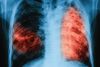 Безплатен скрининг за риск от туберкулоза в  МБАЛ”Д-р Атанас Дафовски”АД
