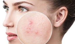 Три дни безплатни прегледи във ВМА на пациенти с акне