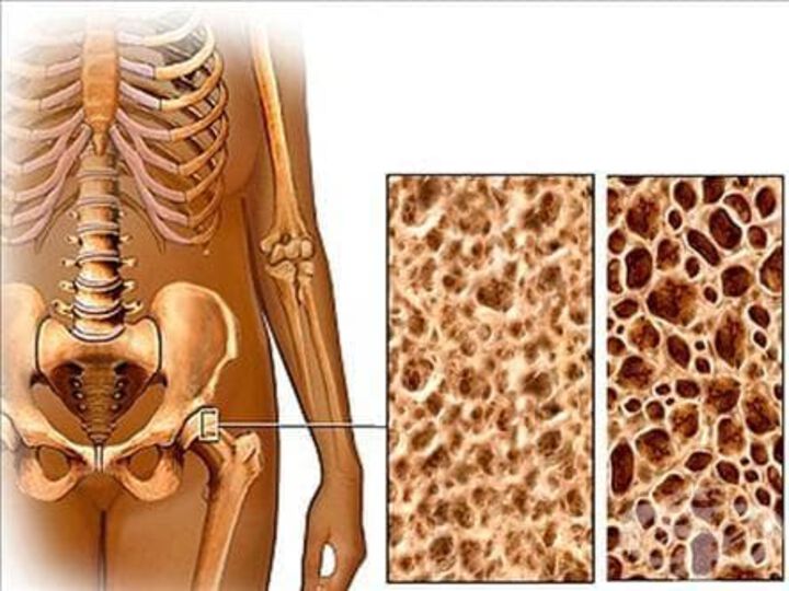 Остеопорозата е разпространено заболяване, но се неглижира в България