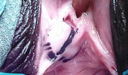 Кисти или абсцес на Скениевите жлези  (парауретрални кисти на Скениевите жлези - Скенит)