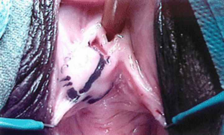 Кисти или абсцес на Скениевите жлези  (парауретрални кисти на Скениевите жлези - Скенит)