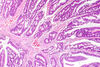 Първичен аденокарцином на влагалището от чревен тип- случай на рядък гинекологичен тумор.