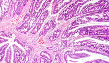Първичен аденокарцином на влагалището от чревен тип- случай на рядък гинекологичен тумор.