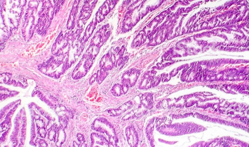 Първичен аденокарцином на влагалището от чревен тип- случай на рядък гинекологичен тумор.