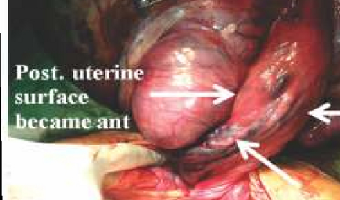 Рядък случай на акушеро-гинекологична спешност:  Остро настъпила торзия на матката по време на бременност в 33 г.с.