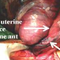 Рядък случай на акушеро-гинекологична спешност:  Остро настъпила торзия на матката по време на бременност в 33 г.с.