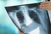 Трайно намалява броят на болните от туберкулоза в страната