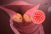 HPV асоциирани заболявания и възможности за тяхната профилактика