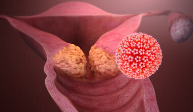 HPV асоциирани заболявания и възможности за тяхната профилактика
