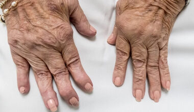 Какво представлява ревматоидният артрит?
