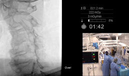 В МБАЛ „Уни Хоспитал“ бе извършено  стентиране на каротидна артерия