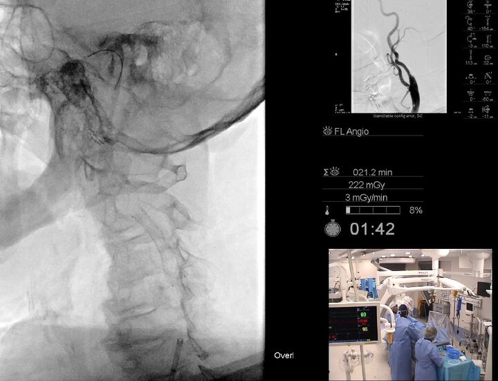 В МБАЛ „Уни Хоспитал“ бе извършено  стентиране на каротидна артерия
