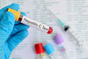 9 от 10 българи не знаят, че са заразени с хепатит