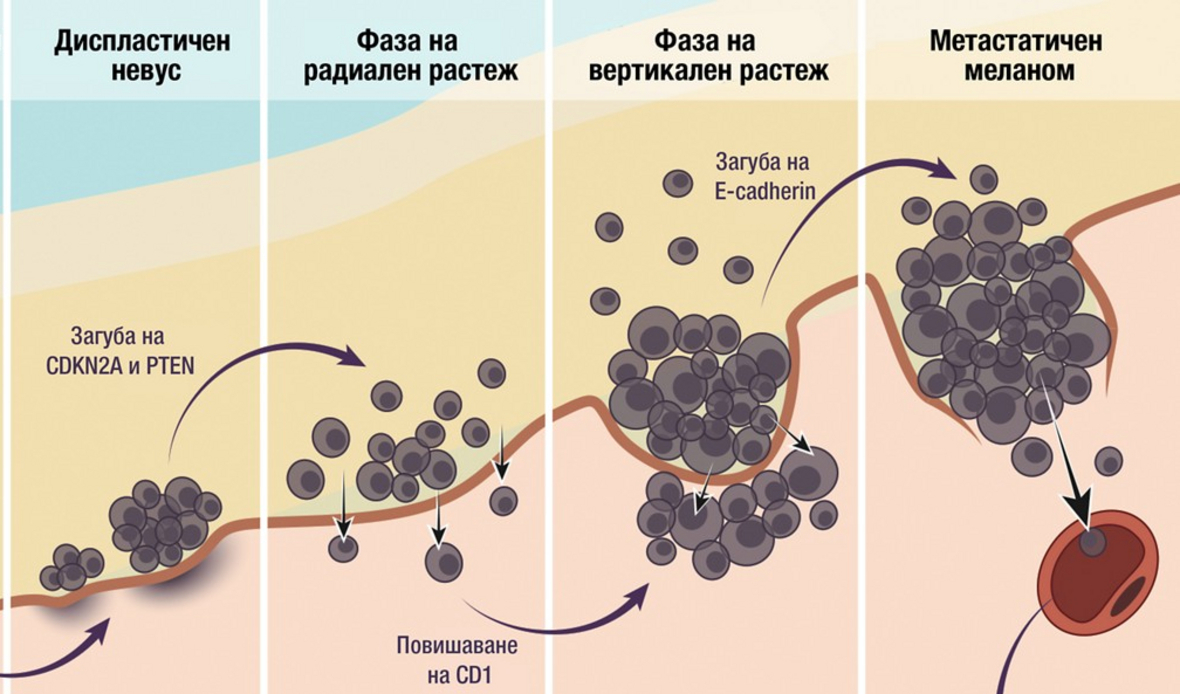 Меланома картины