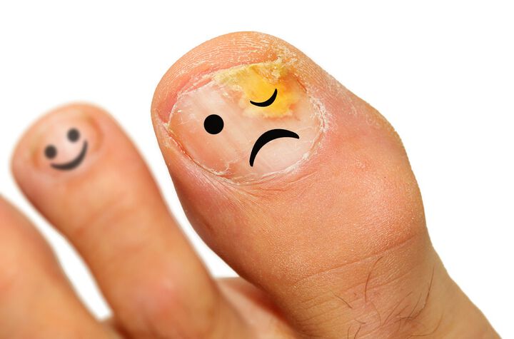 Дерматолог: Гъбичките по ноктите са "врата" за инфекции, не отлагайте лечението