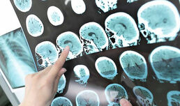 Нови методи за невростимулация дават надежда за пациенти с парализи, МС и болки в гърба
