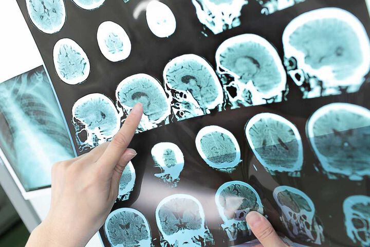 Нови методи за невростимулация дават надежда за пациенти с парализи, МС и болки в гърба
