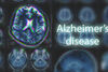 Ново лекарство срещу Алцхаймер се бори с причинителя на болестта