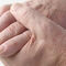9 необичайни симптоми, свързани с ревматоиден артрит