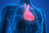 Усложнения при сърдечната ресинхронизираща терапия