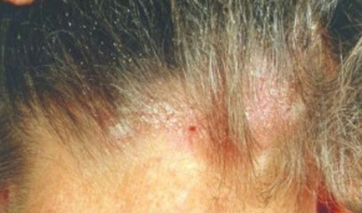 Себореен дерматит екзема на главата и тялото – какво е лечението? Д-р Малена Герговска, дм
