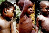 Маймунска вариола (Monkeypox)- Въпроси и отговори