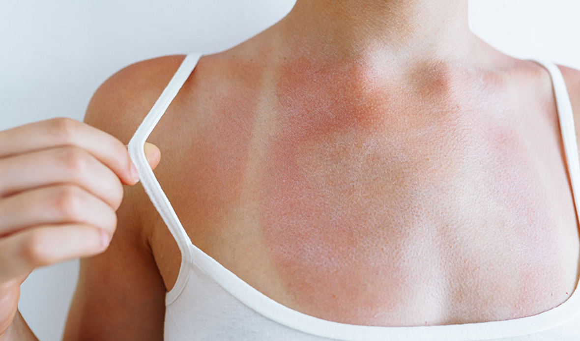 Алергиите при децата през лятото - превенция и защита