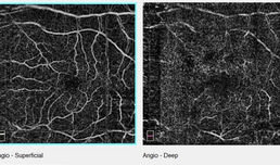 ОСТ-Ангиография- Безконтрастно изследване на съдовете на окото